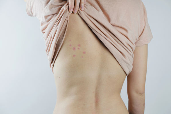 Red, raised welts in the common linear "breakfast, lunch, dinner" pattern on the back of a person, demonstrating what bed bug bites look like.
